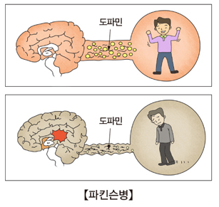 파킨슨병 도파민