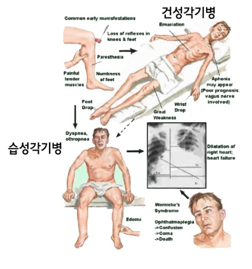 각기병 비타민 부족