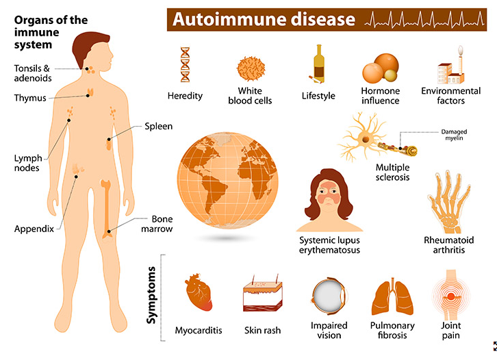 자가면역질환 종류