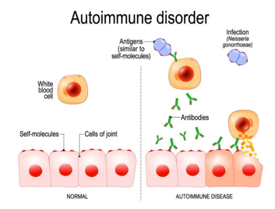 자가면역질환 치료방법