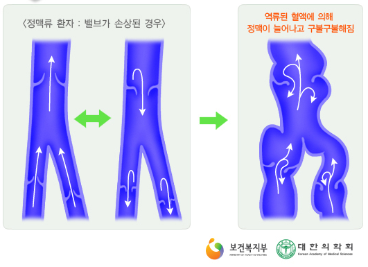 하지정맥류 원인