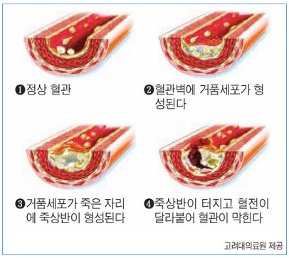 칼슘의 석회화